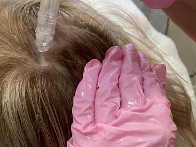 Газожидкостный пилинг волосистой части головы